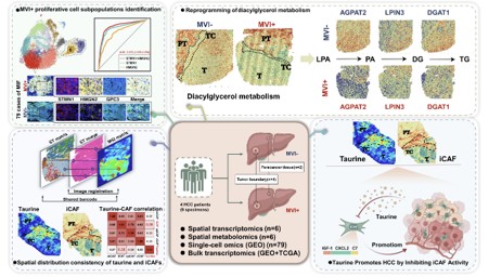 Spatial transcriptomic-metabolic features of tumor foci and tumor capsule in microvascular invasion with hepatocellular carcinoma: A spatial multi-omics study